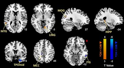 Efficacy and Mechanism of Moxibustion Treatment on Mild Cognitive Impairment Patients: An fMRI Study Using ALFF